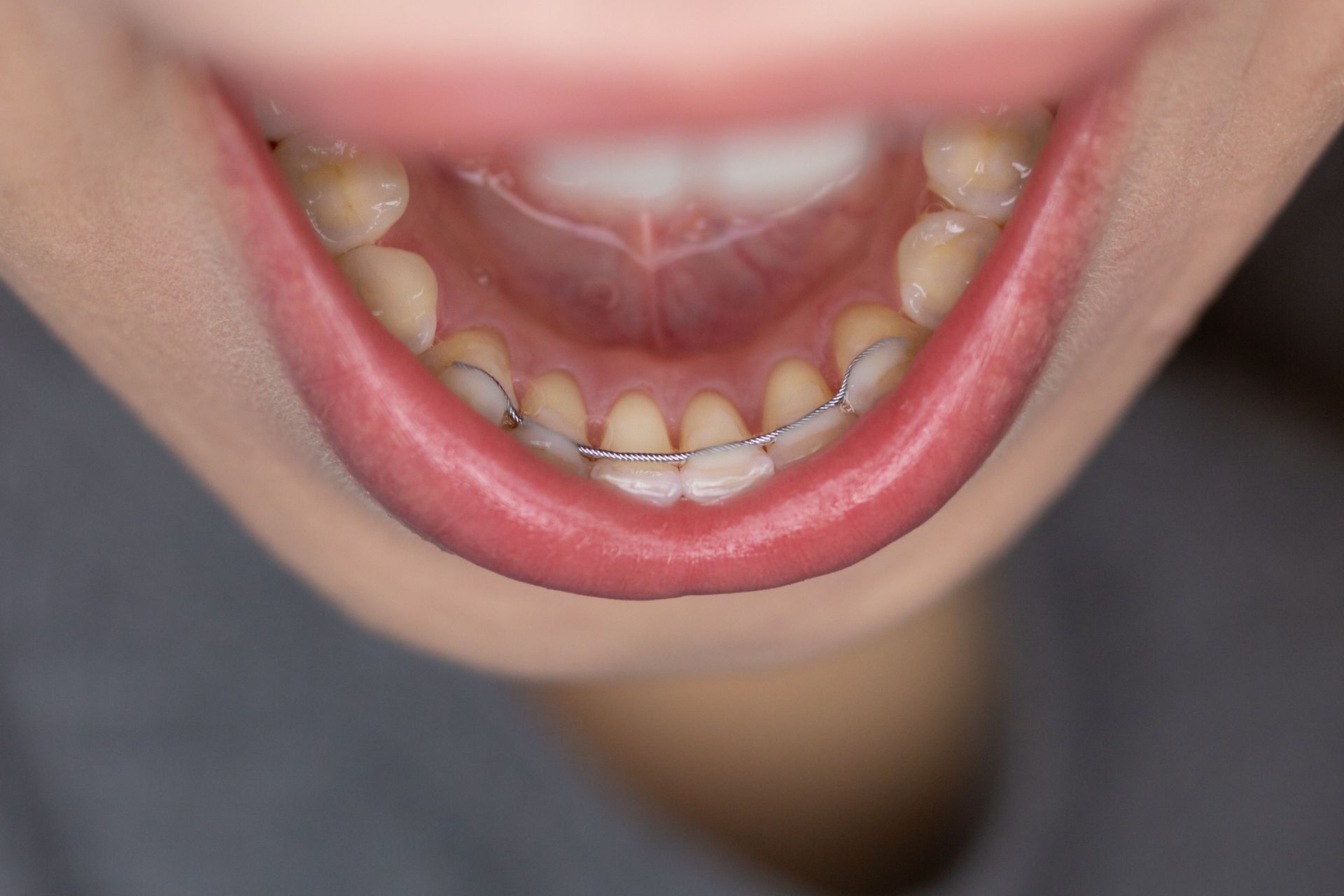 permanent retainer on patient