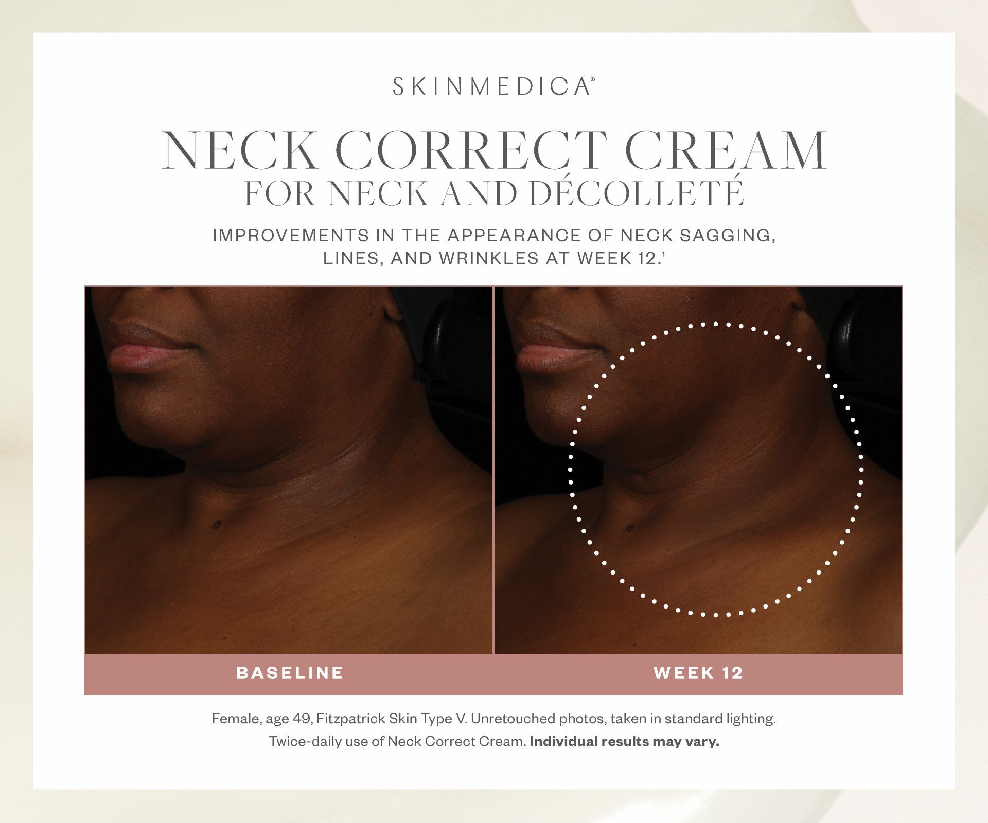 A woman 's neck is shown before and after using neck correct cream