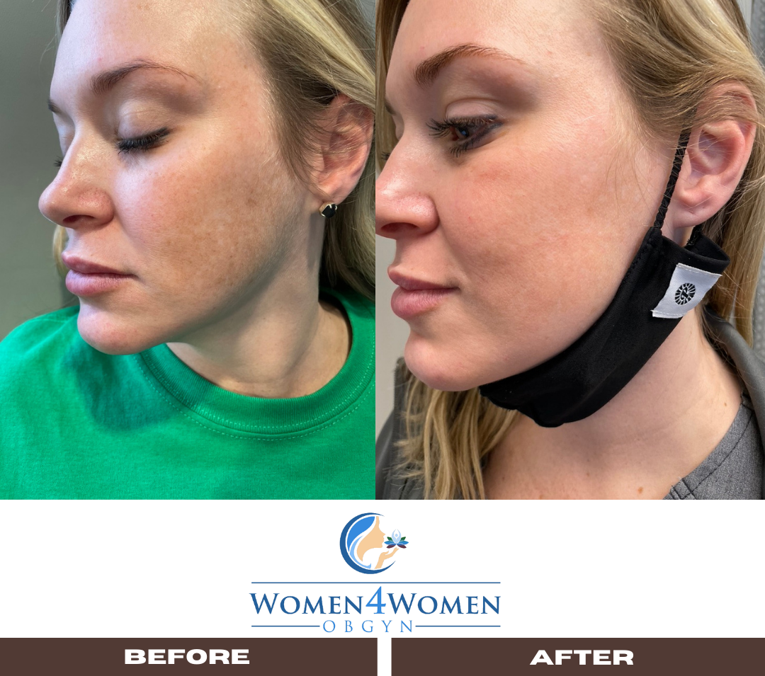 A before and after photo of a woman wearing a mask