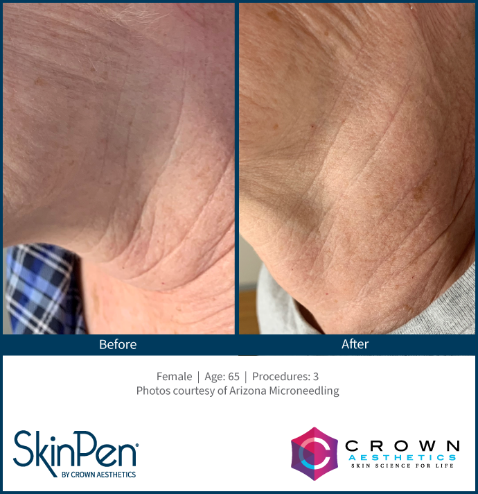 Before and After SkinPen