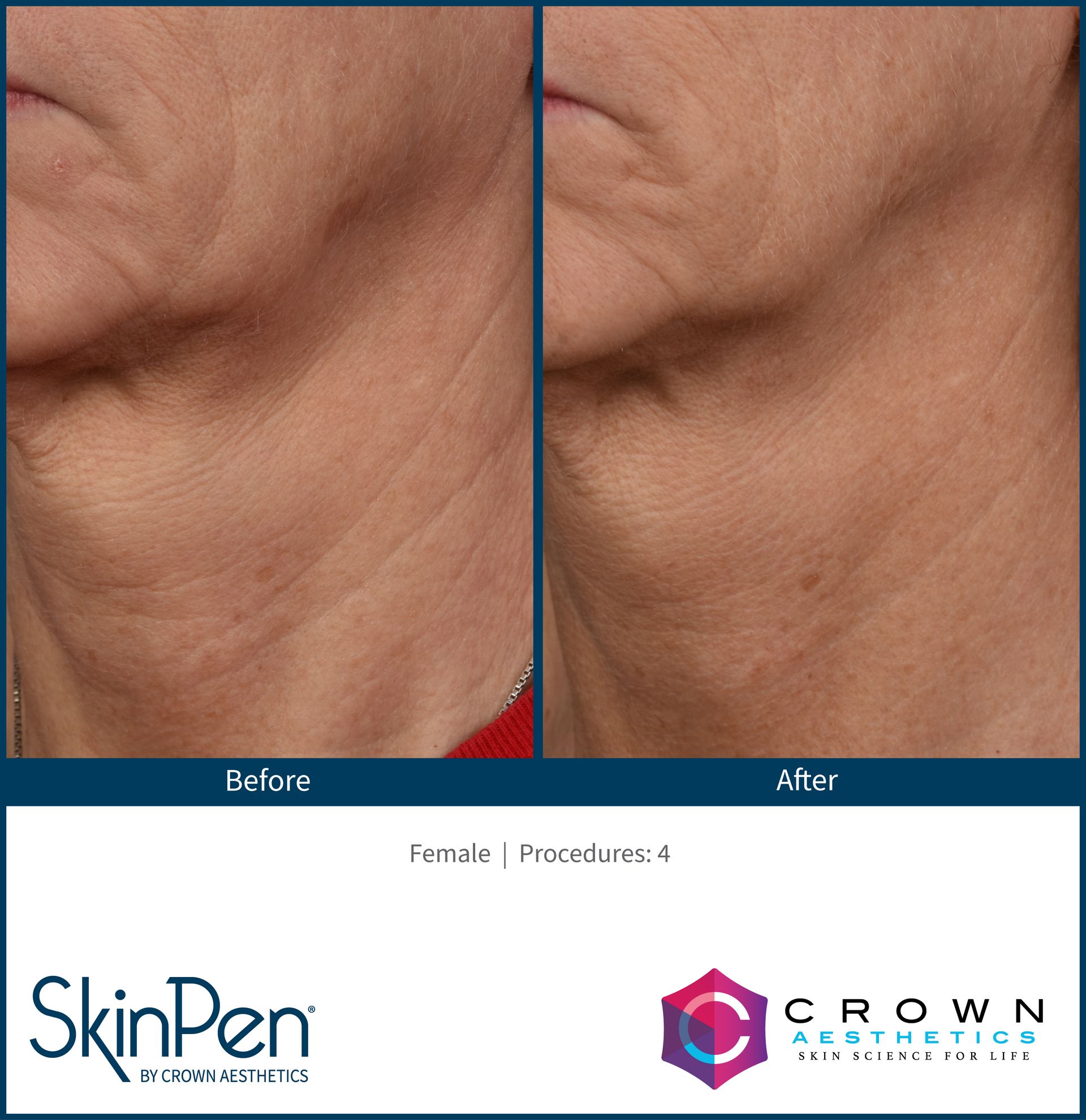 Before and After SkinPen