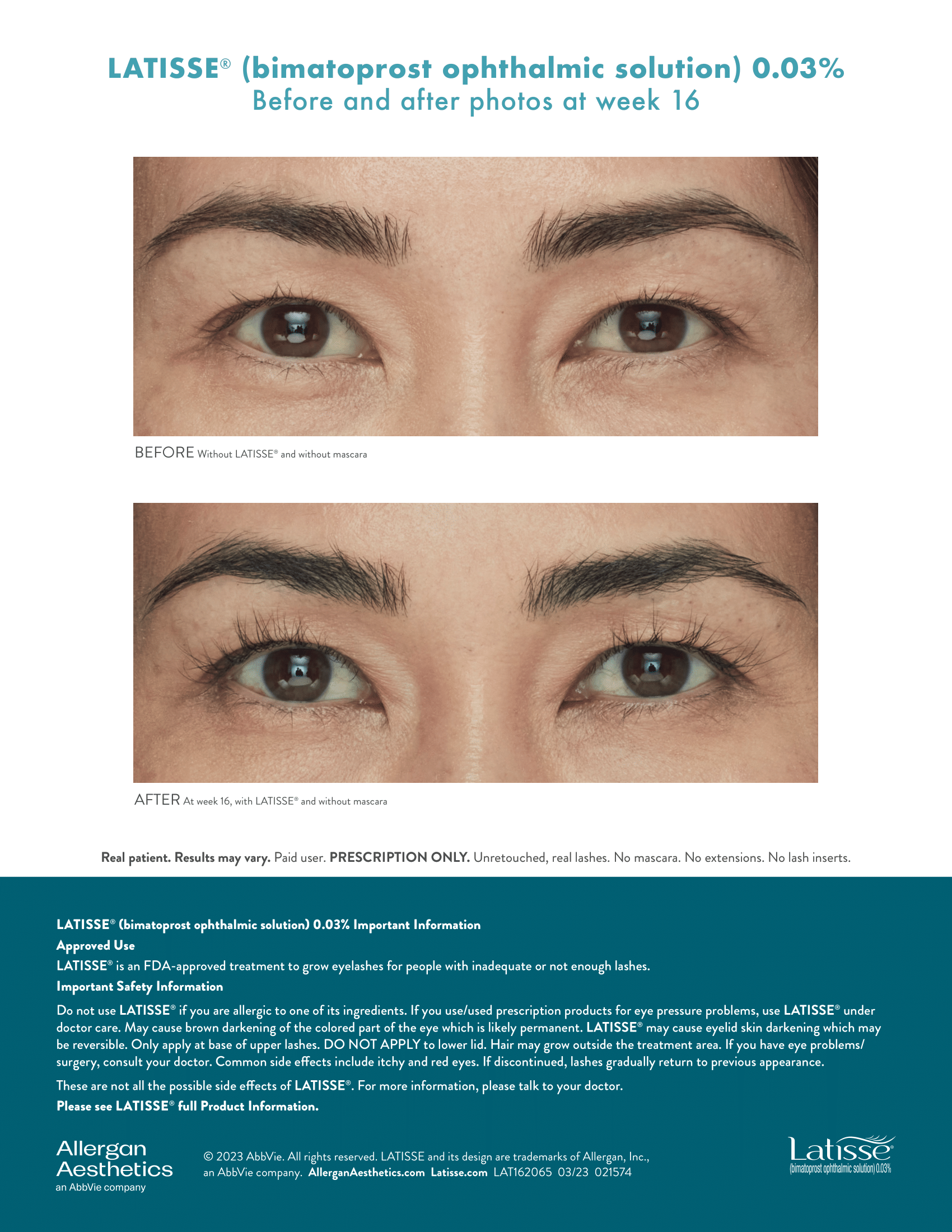 Before and After Latisse