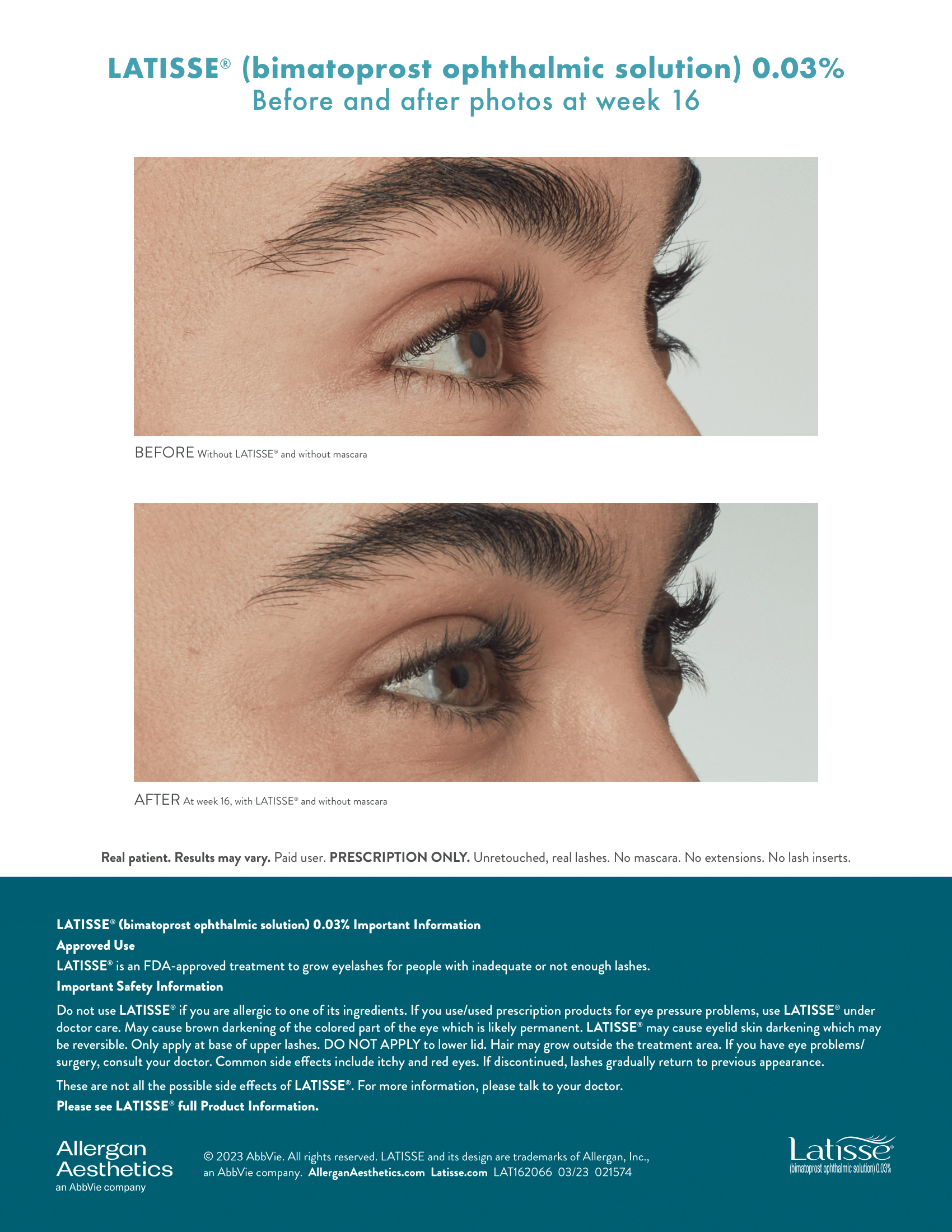 Before and After Latisse