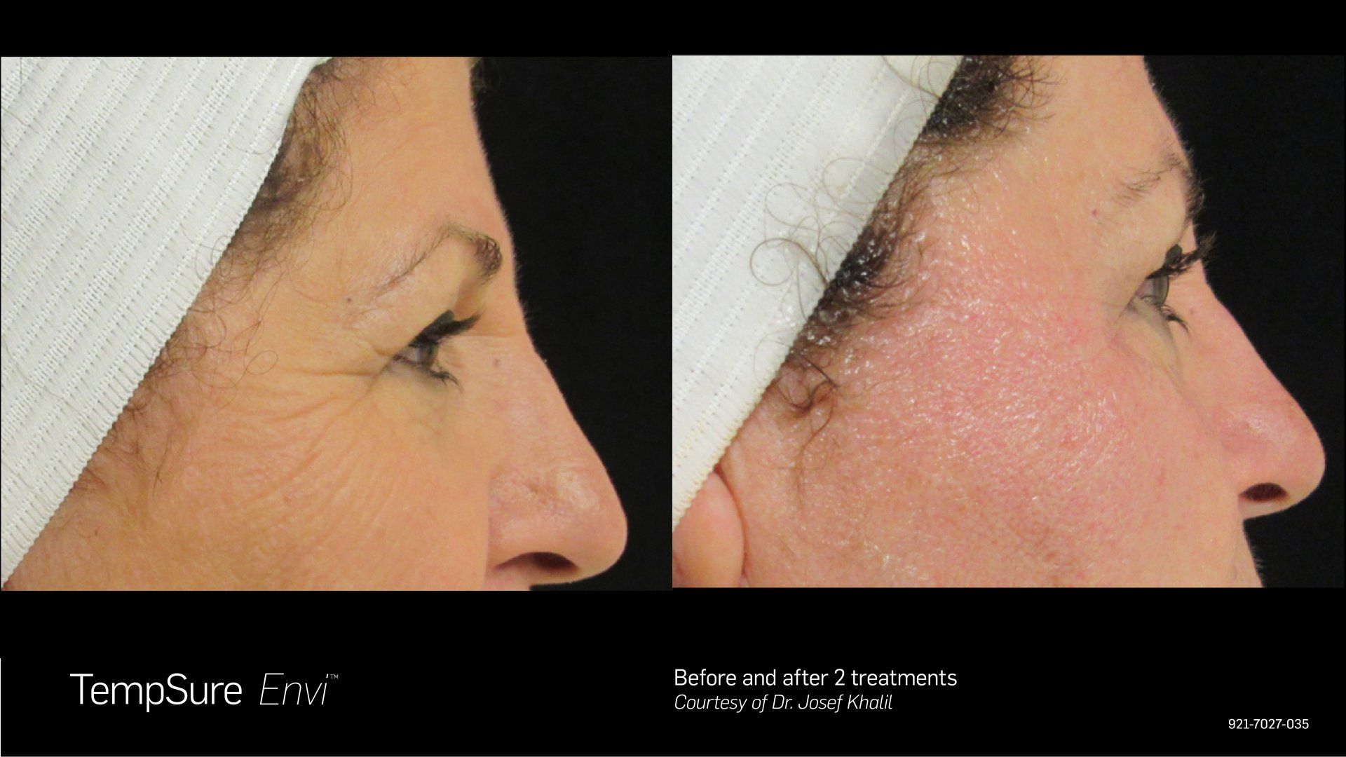 A before and after photo of a woman 's face