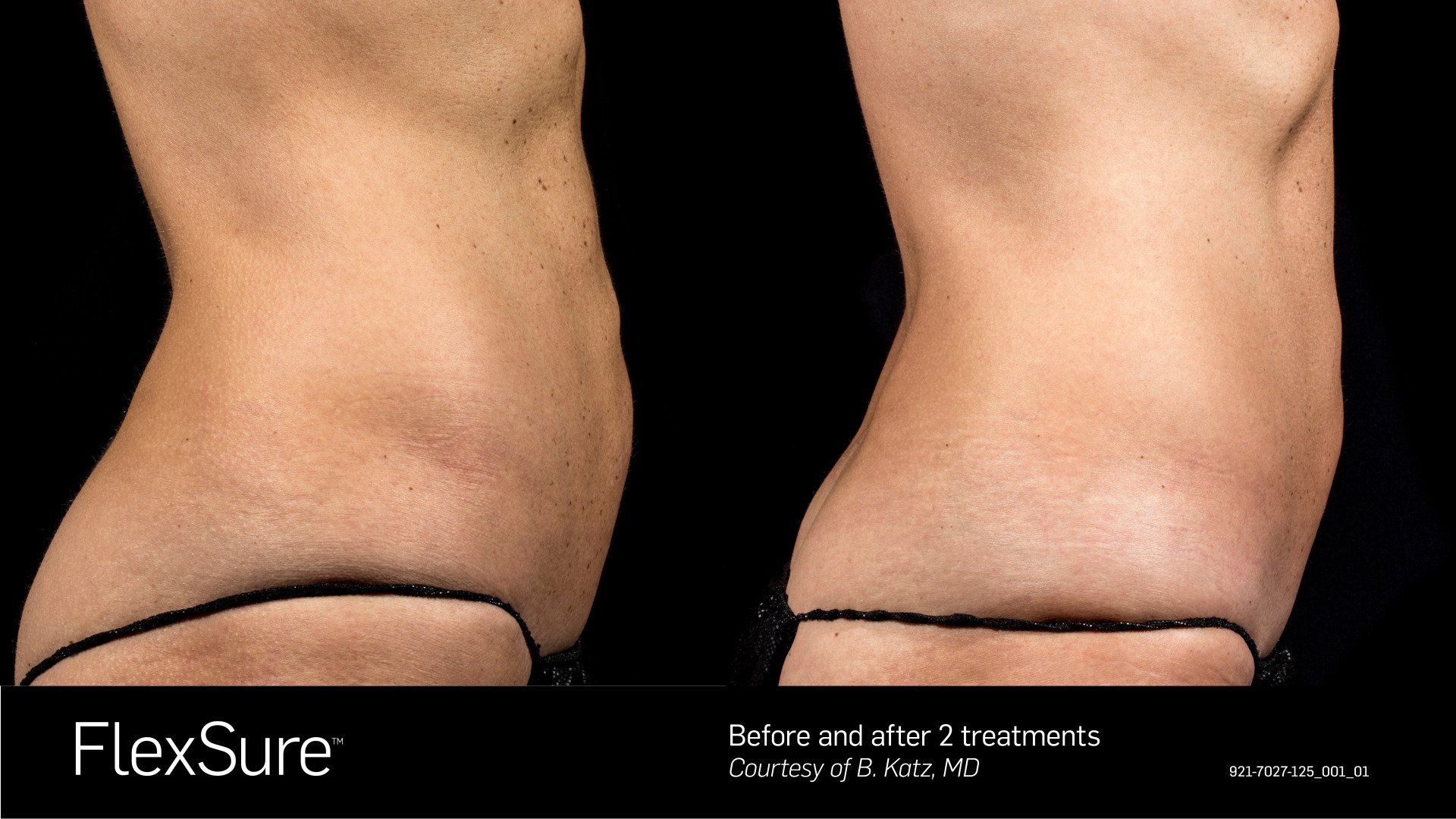 before and after FlexSure body contouring treatment at Women4Women