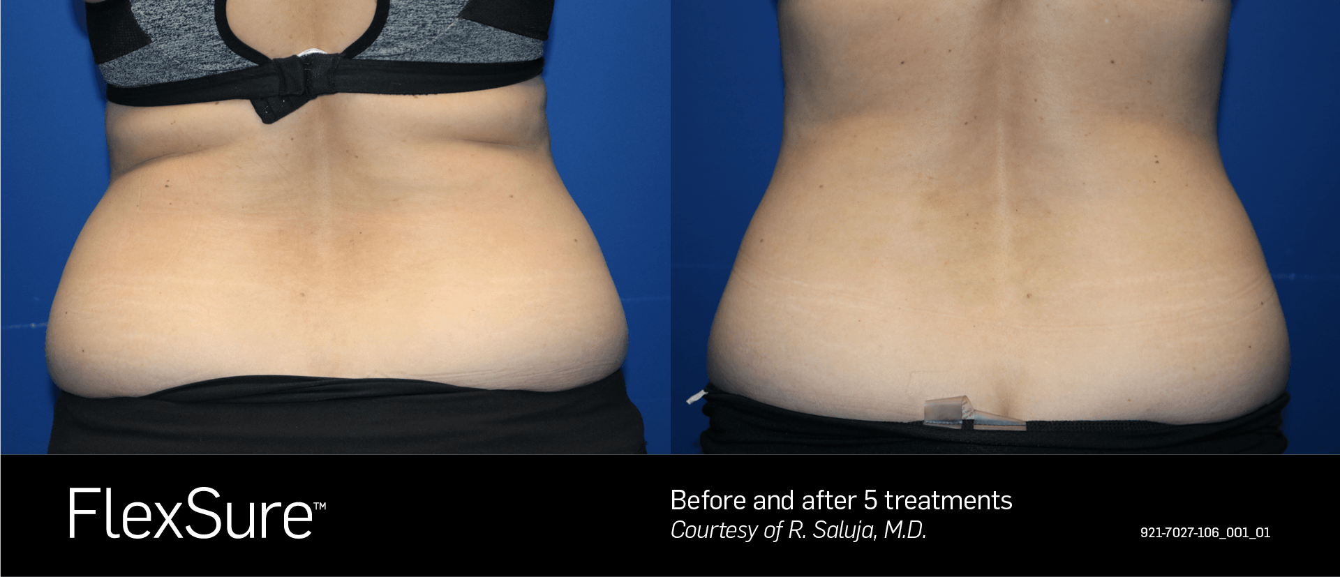 A woman 's back before and after a flexsure treatment