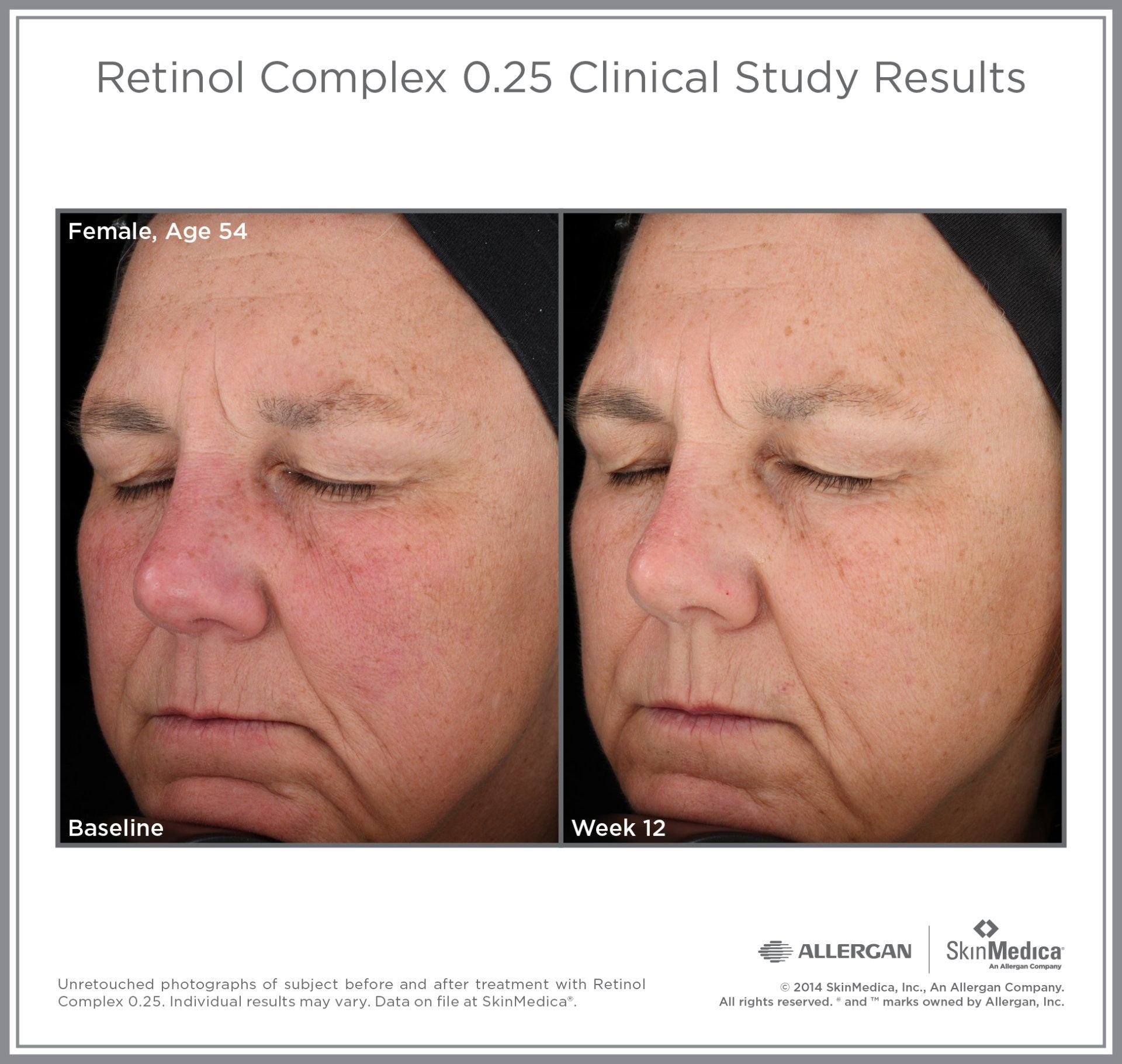 A before and after photo of a woman 's face with the caption retinol complex 0.25 clinical study results