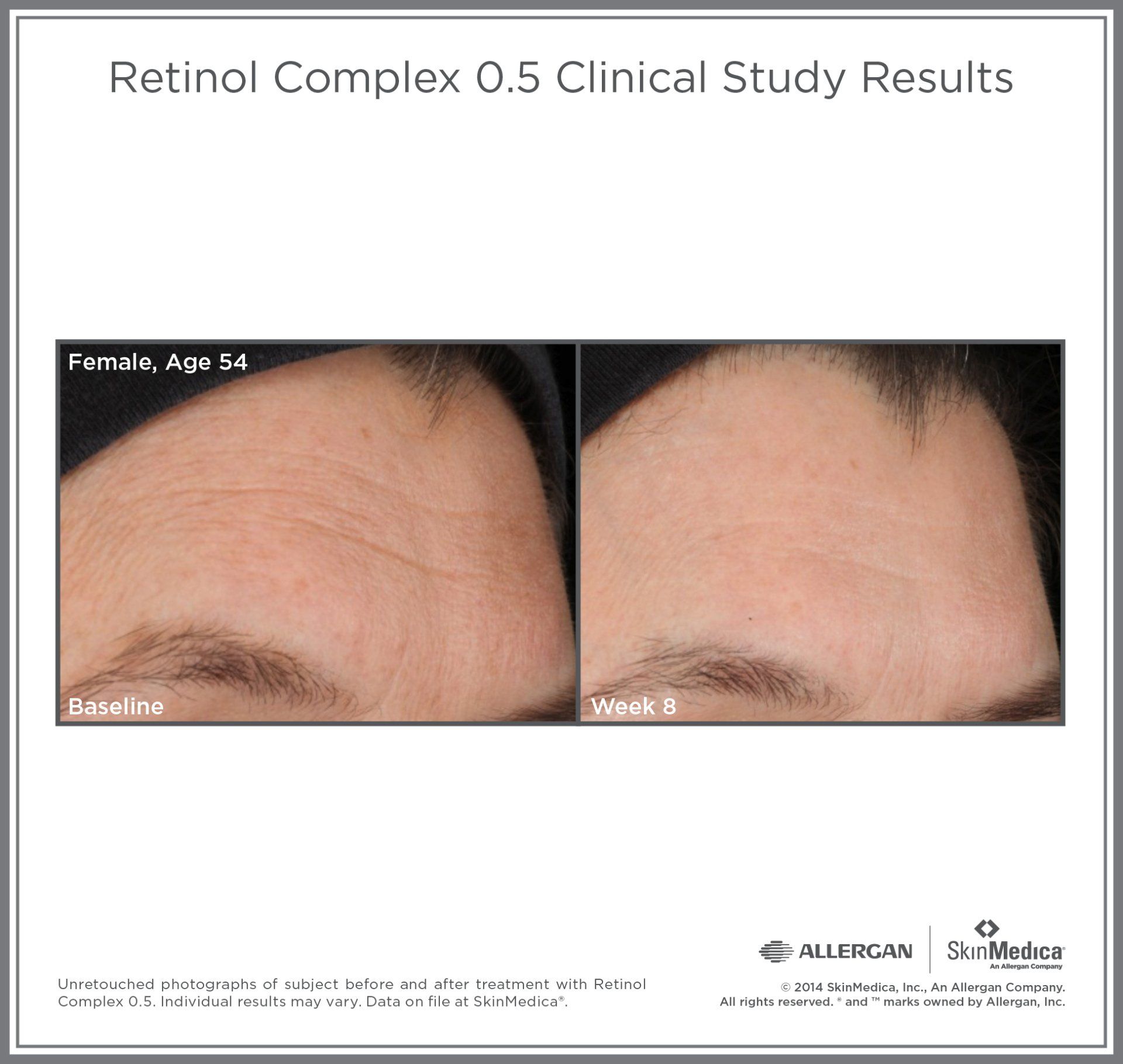 A before and after photo of a woman 's forehead with the caption retinol complex 0.5 clinical study results