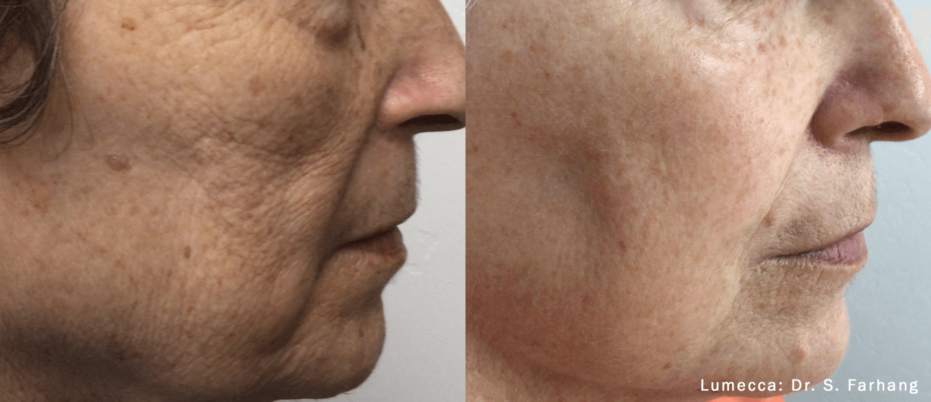 A before and after photo of a woman 's face.