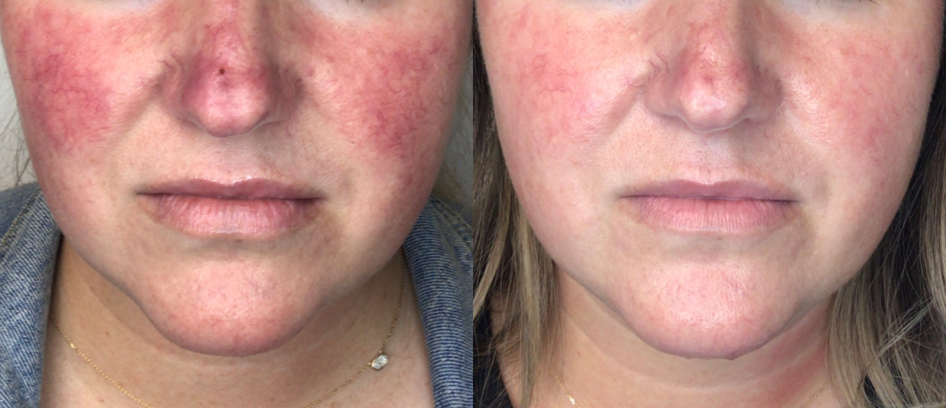 A before and after photo of a woman 's face with red spots.