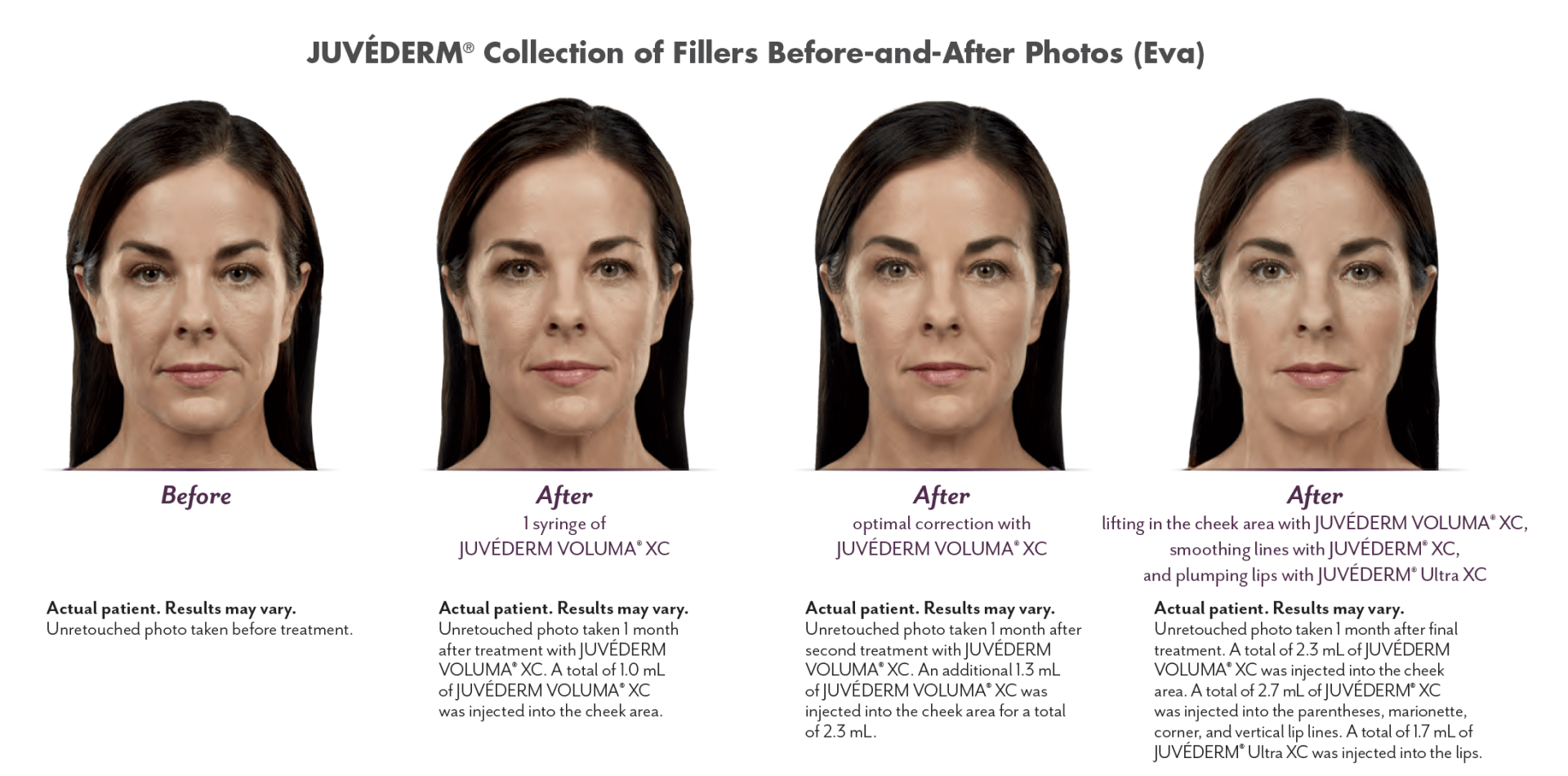 Juvéderm fillers before & after