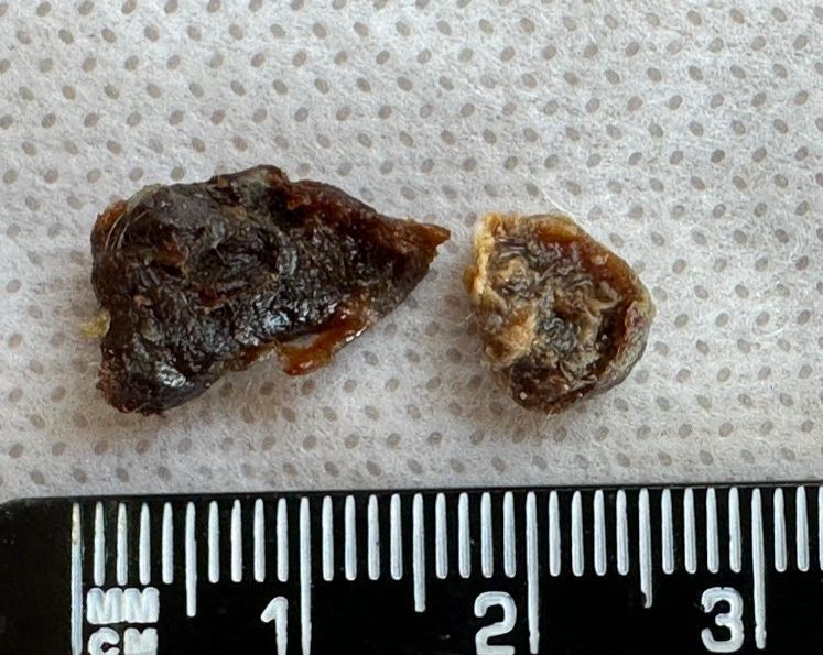 wax following an ear wax removal in Coventry using ear irrigation