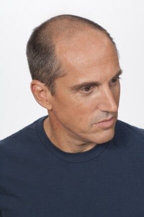 Hair Loss — Philadelphia, PA — Carmine's Hair Studio