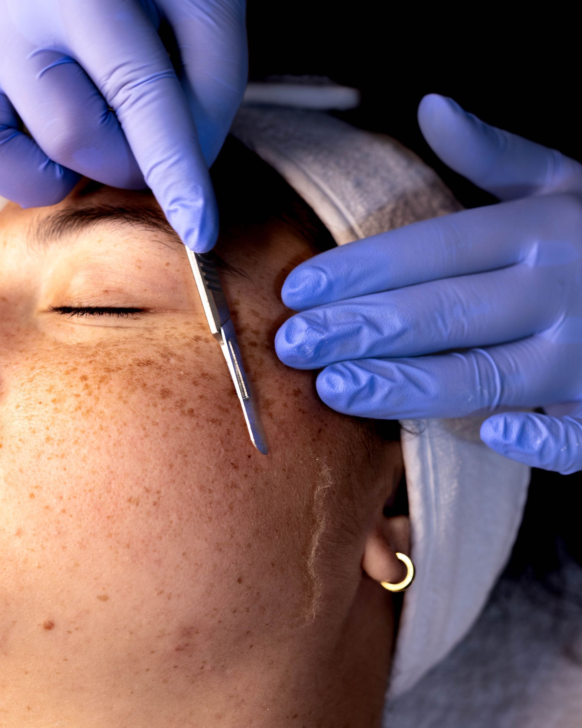 A person's face with freckles being scraped by a metal tool held by gloved hands.