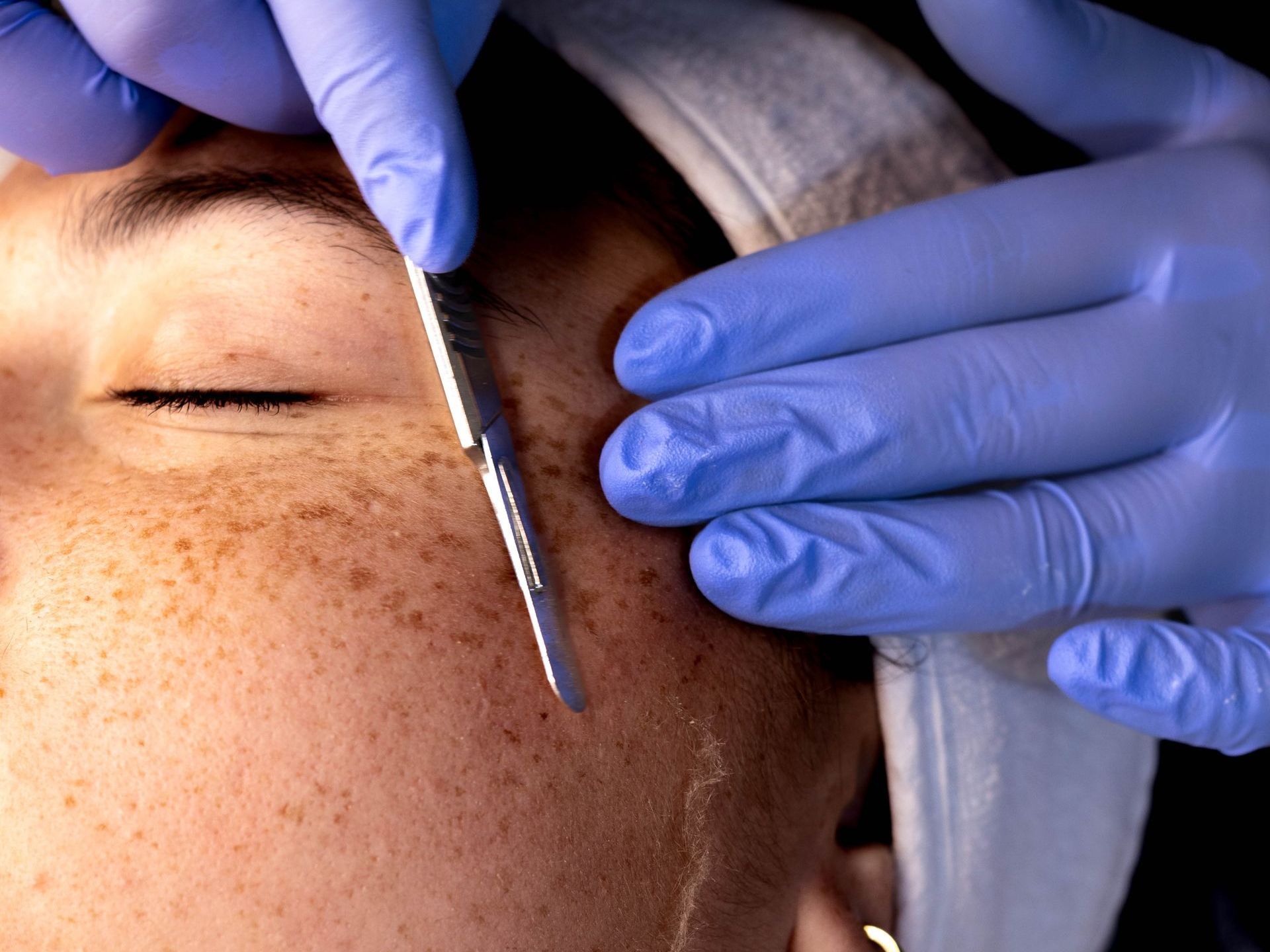 a woman getting dermaplaning done