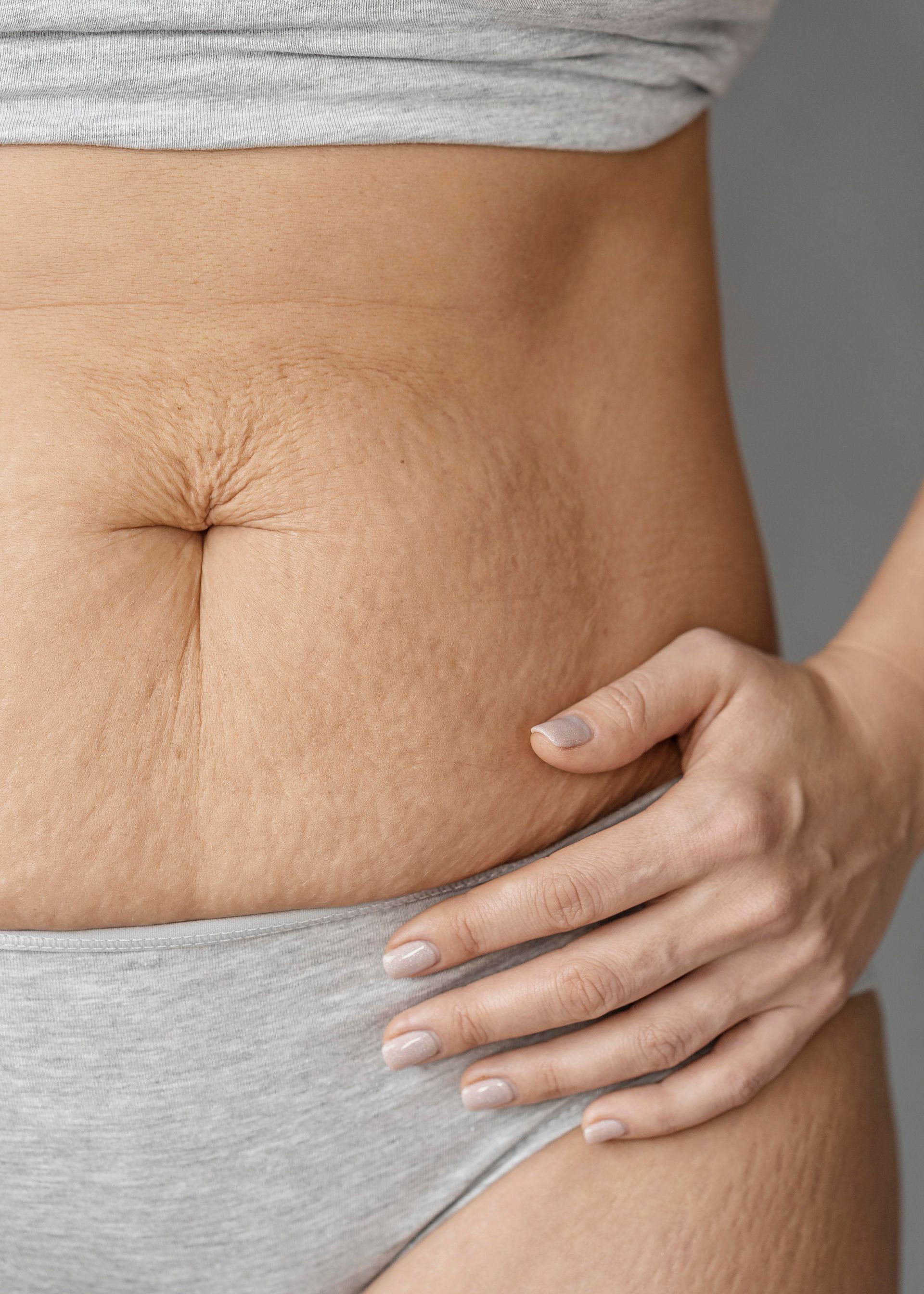 Close-up of a person's midsection and hip showing skin texture and stretch marks, with a hand resting on the hip.