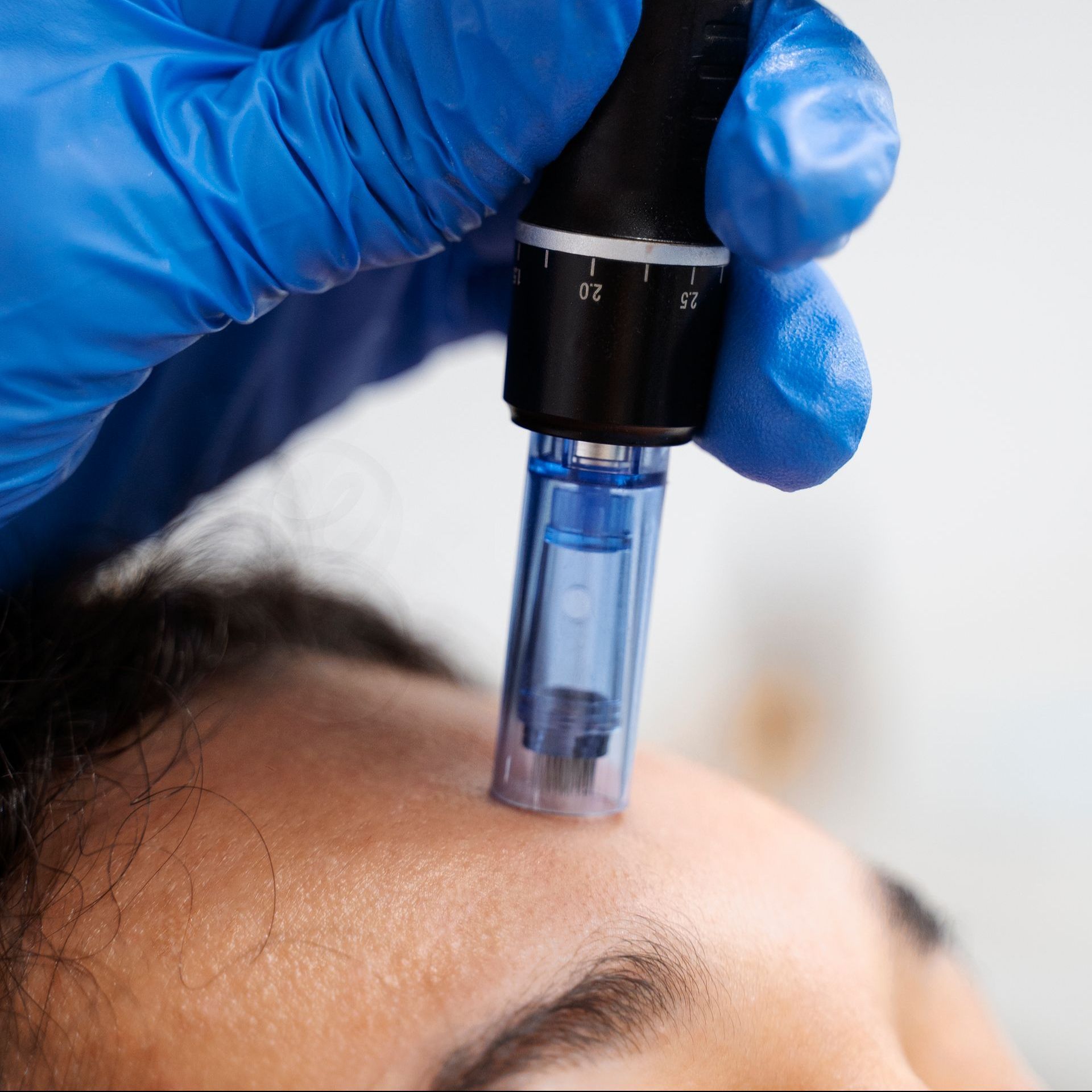 a microneedling device on a forehead
