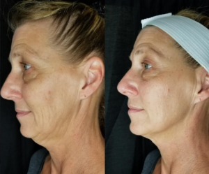 Side-by-side comparison of a person's profile before and after a cosmetic procedure, showing reduced wrinkles and tighter skin.
