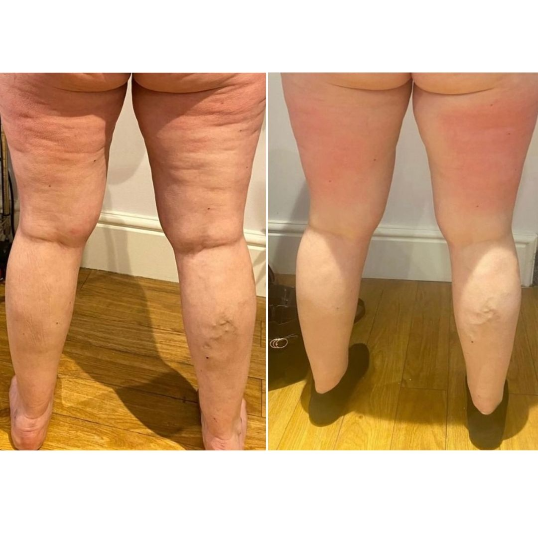 Two legs side-by-side. Left leg shows cellulite. Right leg is smoother with red patches.