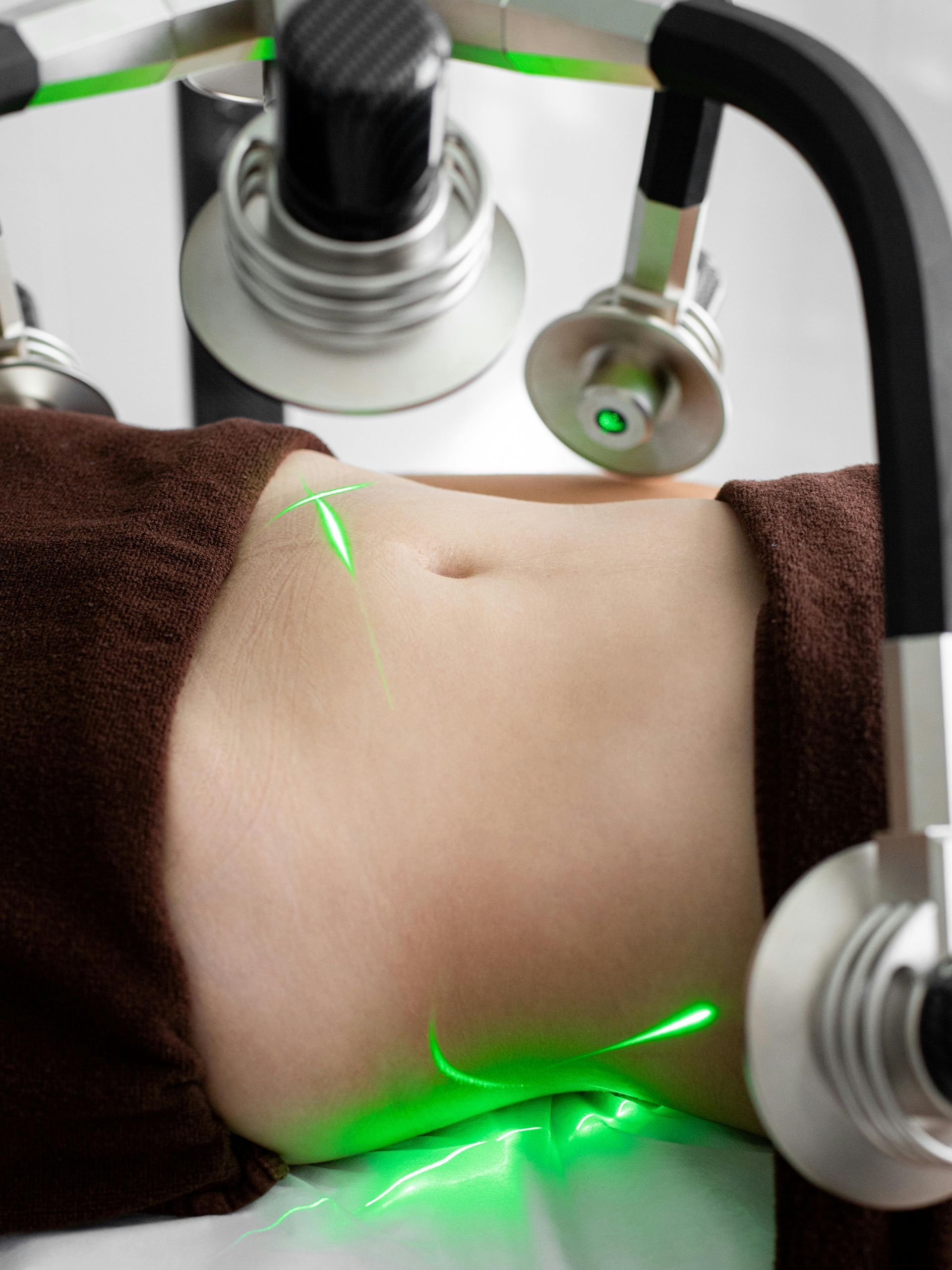Laser treatment on a person's abdomen. Green laser lights are visible, with equipment overhead.