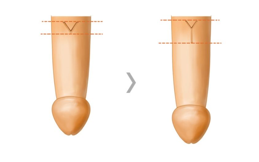 釜山西面 Urogyn 男科診所的 VY 前進皮瓣手術