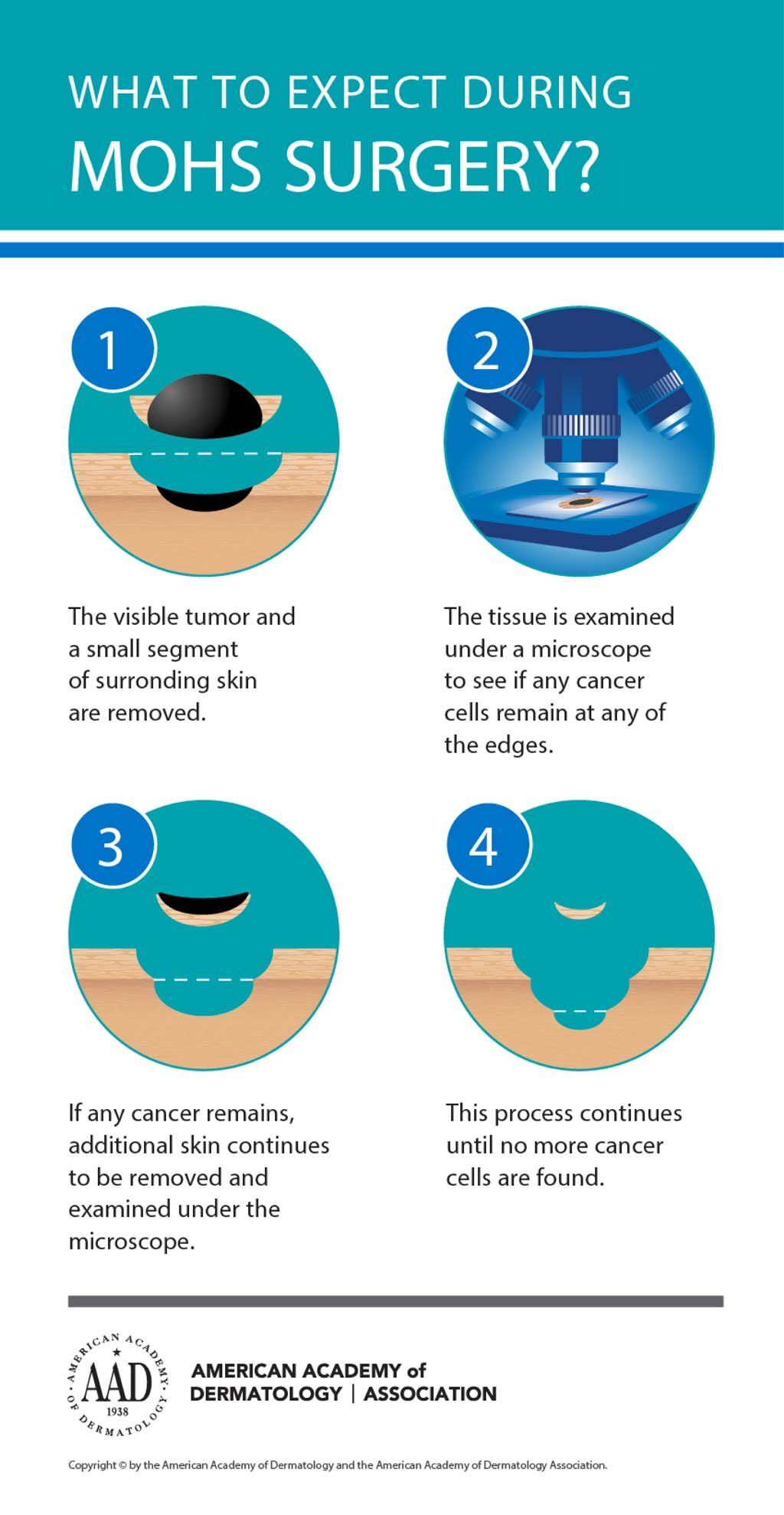 A poster explaining what to expect during mohs surgery.
