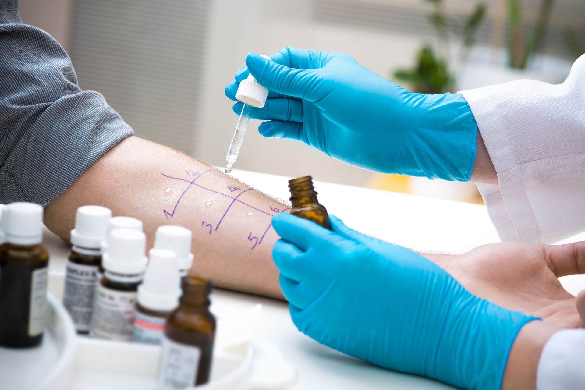 Doctor performing allergy test on a patient's arm, using a dropper and small vials in a medical setting.