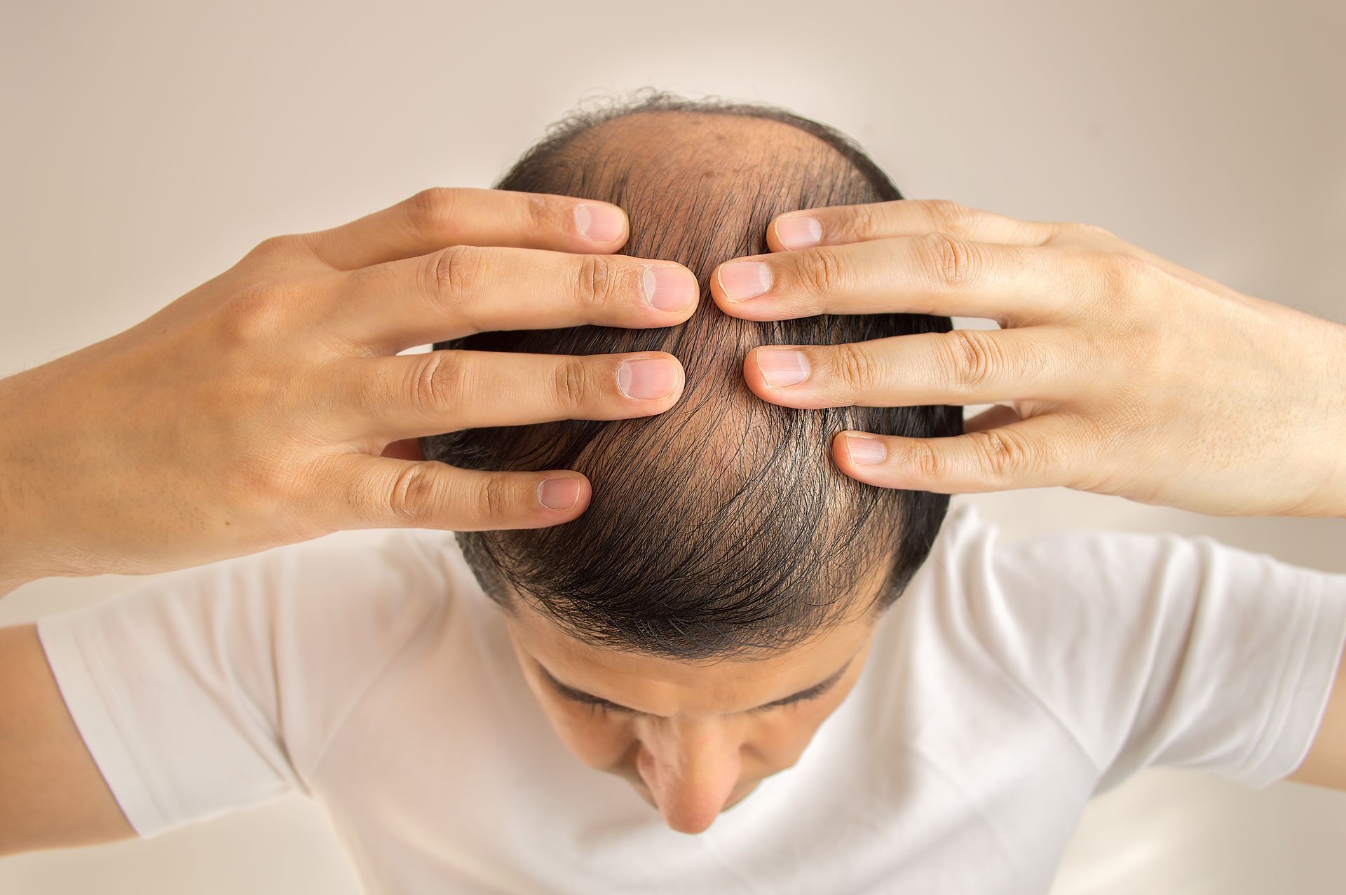 A man is touching his bald head with his hands.
