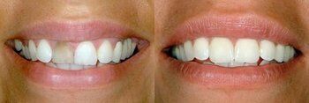 Tooth Restoration — Before and After of a Woman with Tooth Bonding in Hillsborough, NJ