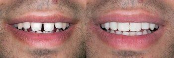 Teeth Repair — Before and After of a Man with Tooth Bonding in Hillsborough, NJ