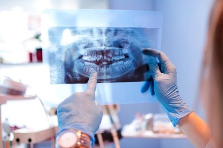Gum Disease — Doctor Pointing at Teeth X-Ray in Hillsborough, NJ