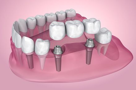 Dental Questions — Implant Supported Fixed Bridge in Hillsborough, NJ