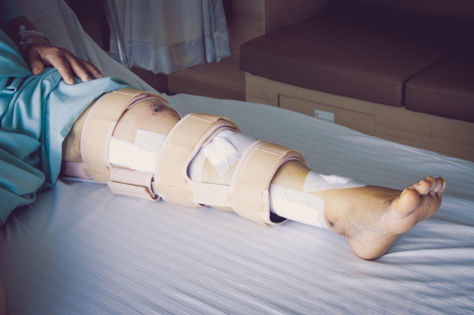 Una gamba immobilizzata dopo un intervento al ginocchio