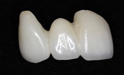 3-unit bridge esthetic options for anterior and posterior bridges