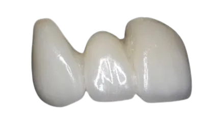 3-unit bridge esthetic options for anterior and posterior bridges