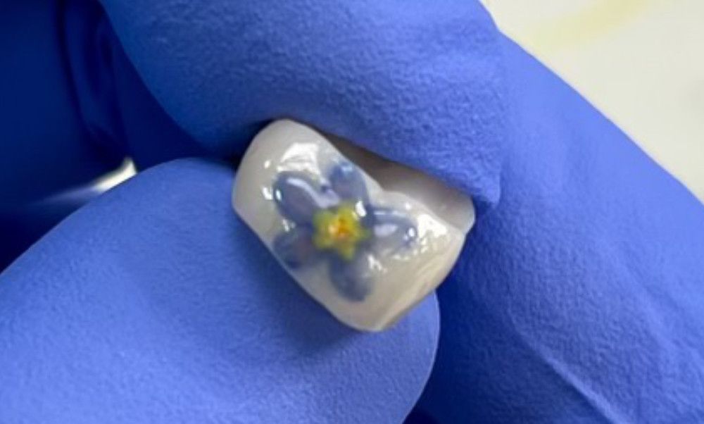 occlusal art on a dental crown 