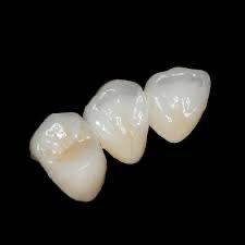 porcelain fused to zirconia anterior