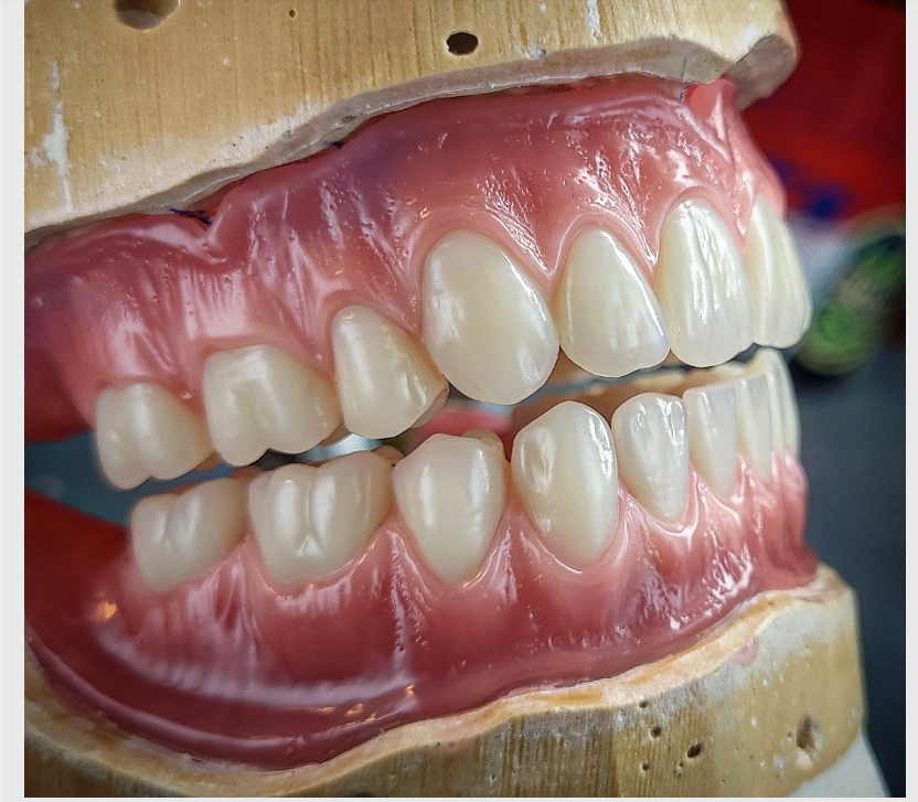 Denture by Summit-Horizon Dental Lab in Bridgeton, MO.