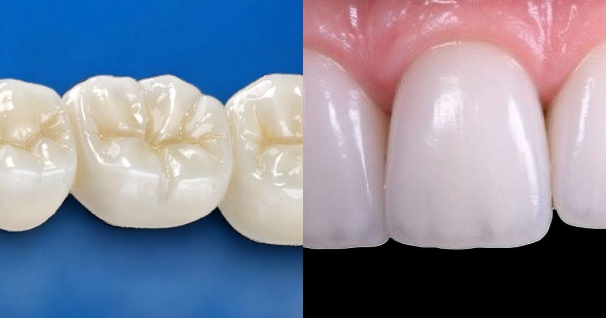 Side-by-side comparison of a full contour zirconia posterior crown and an IPS e.max lithium disilica