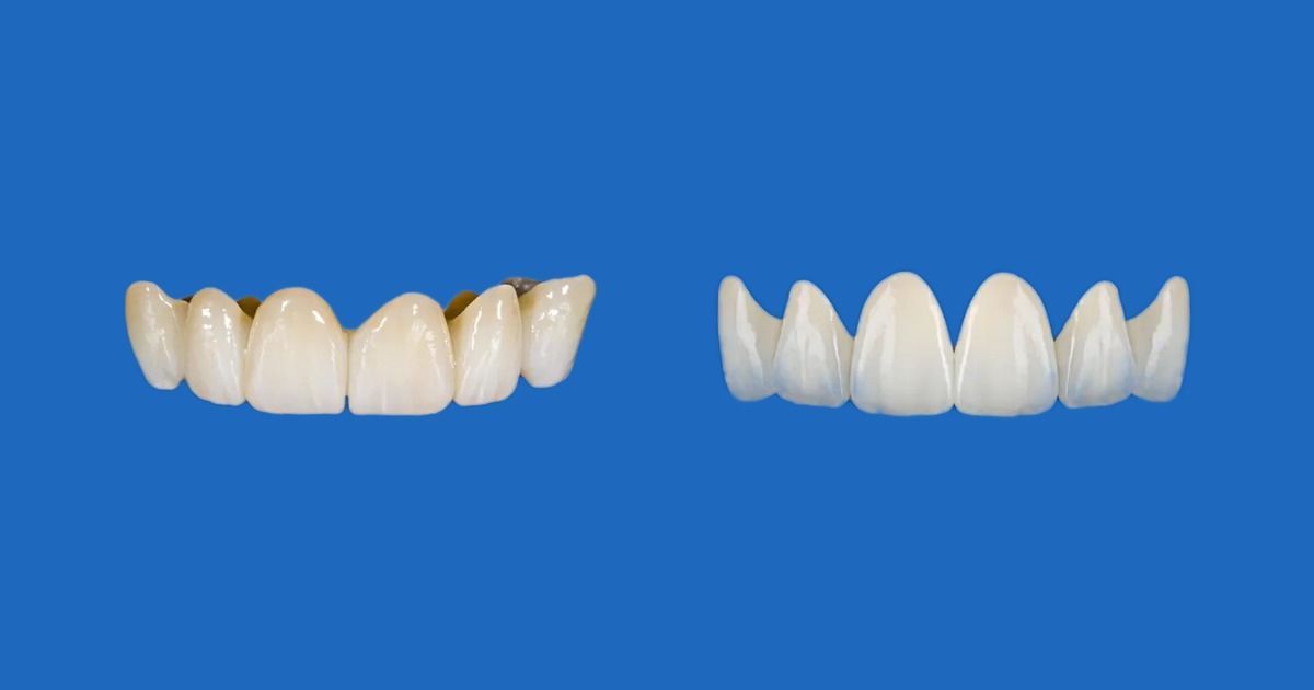 Side-by-side comparison of a multi-layer zirconia bridge and a porcelain layered zirconia bridge on