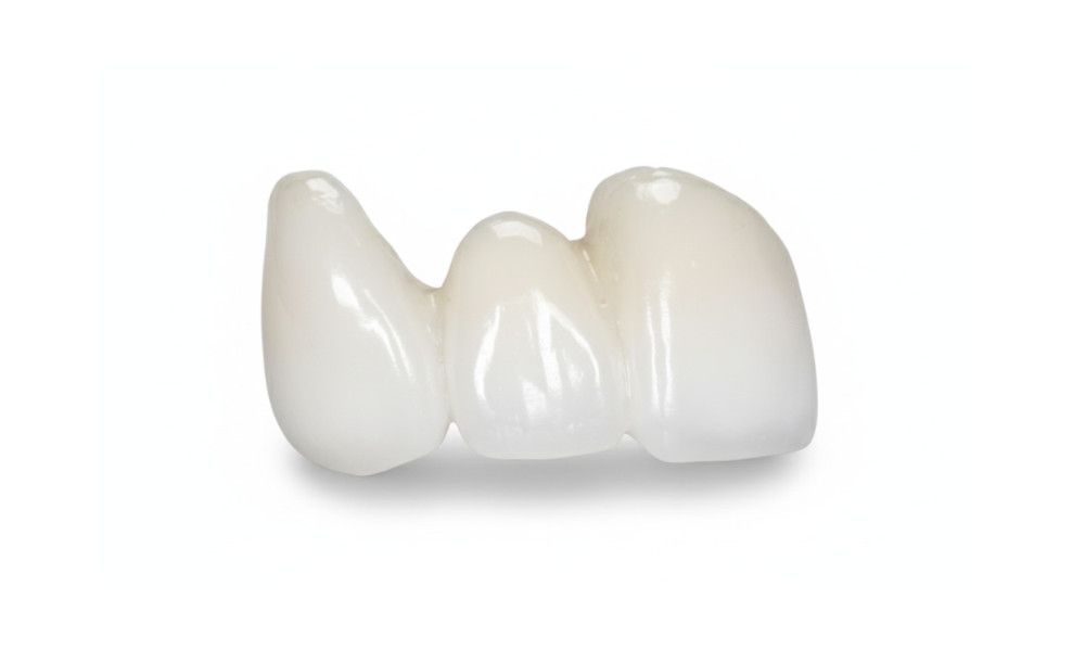 3-unit bridge esthetic options for anterior and posterior bridges