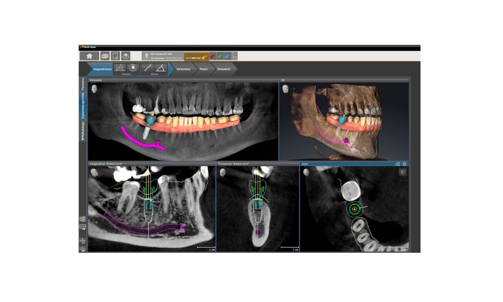 digital implant treatment planning from Summit-Horizon