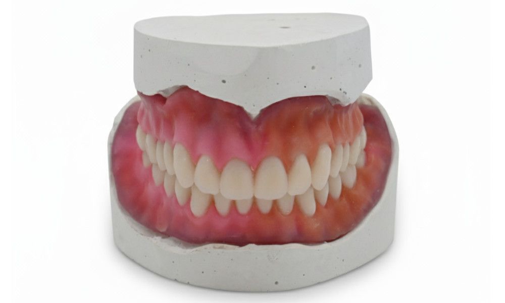 3-unit bridge esthetic options for anterior and posterior bridges