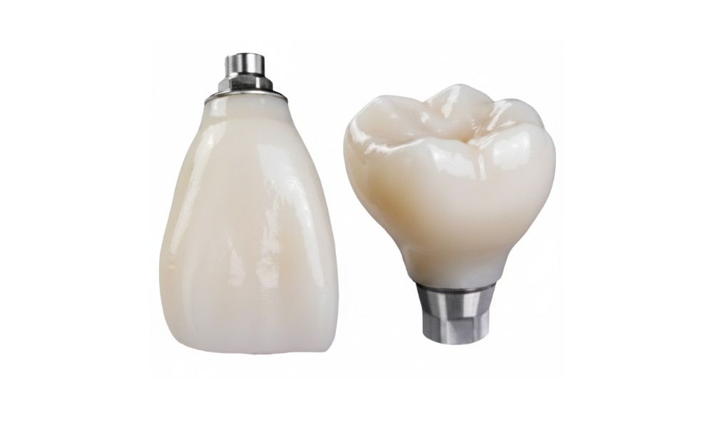 3-unit bridge esthetic options for anterior and posterior bridges