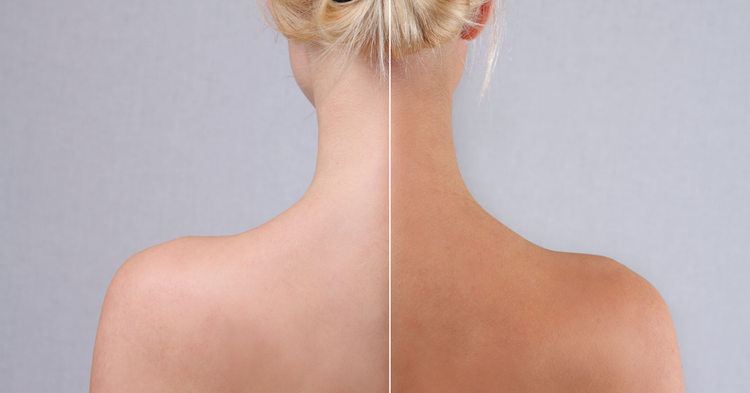 Back of a person's neck and shoulders, showing a stark contrast between untanned skin on the left and tanned skin on the right.