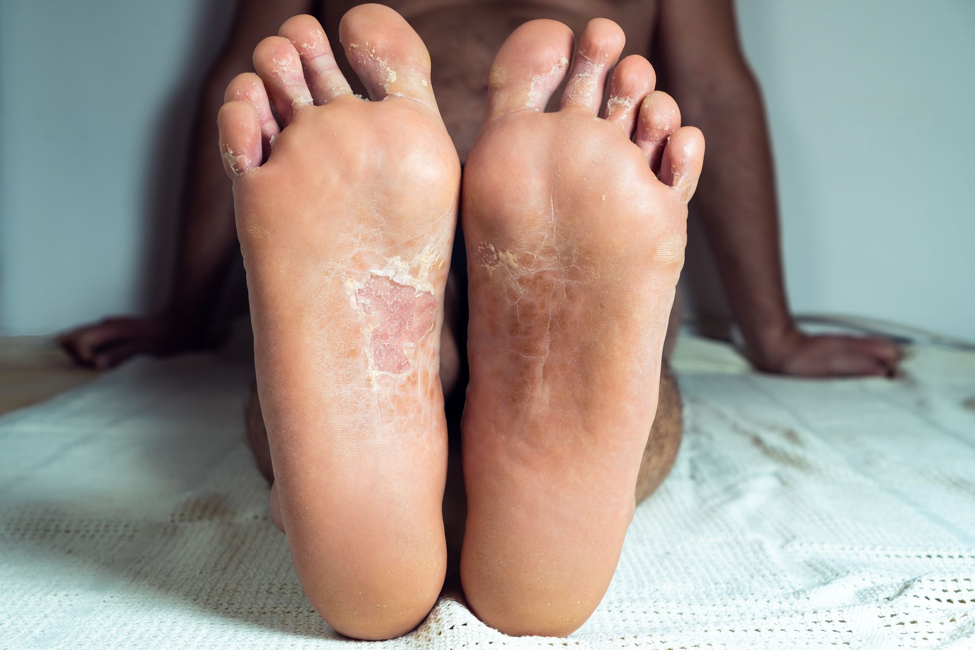 Why See a Podiatrist for Plantar Warts