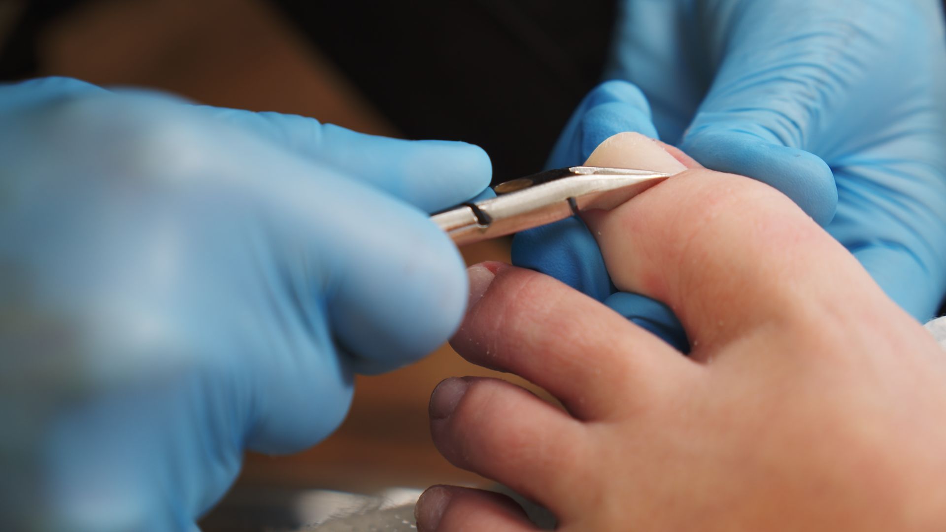 What to Do If You Have an Ingrown Toenail - Cure Podiatry & Wound Care