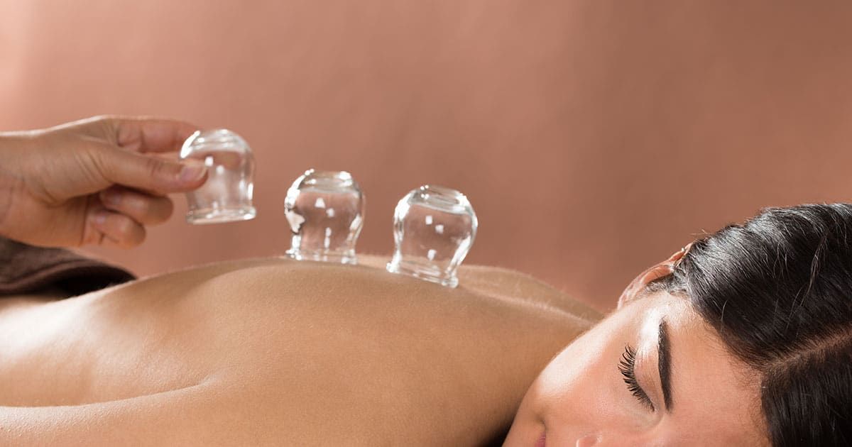 Cupping for Weight Loss – What You Need to Know