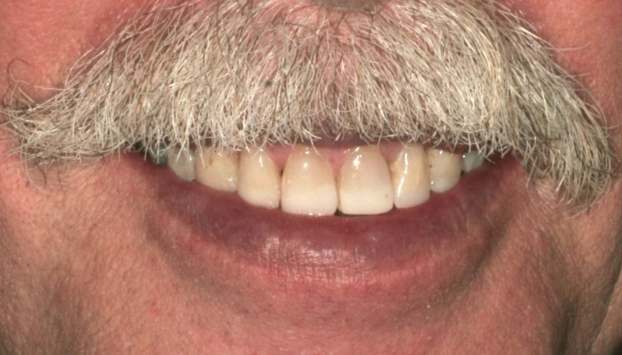 Before Full Mouth Rehabilitation Male Patient — Rogers, AR — Ozark Comprehensive Dentistry