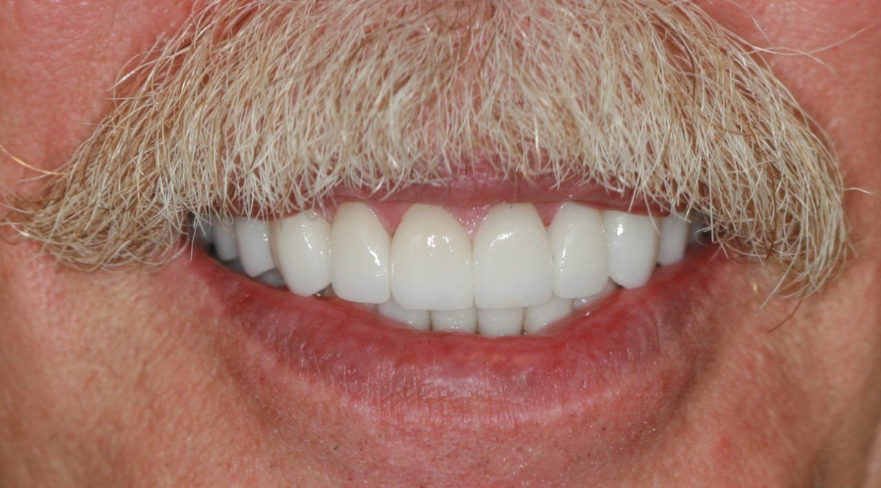 After Full Mouth Rehabilitation Male Patient — Rogers, AR — Ozark Comprehensive Dentistry